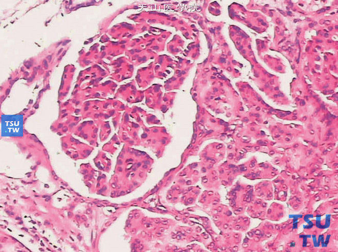 乳头状肾细胞癌，示肾小球样结构