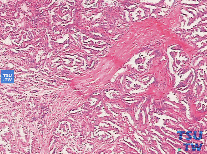 乳头状肾细胞癌，示纤维化的间质