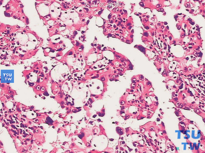乳头状肾细胞癌Ⅱ型，示细胞呈假复层排列