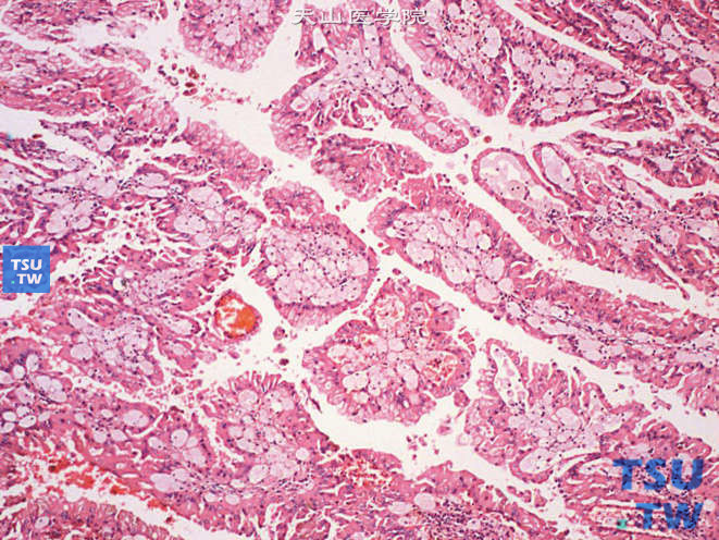 乳头状肾细胞癌，Ⅱ型，示高柱状细胞及泡沫细胞