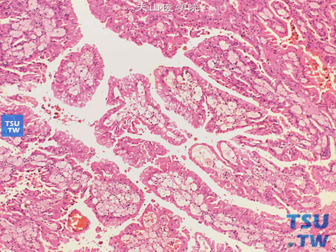 乳头状肾细胞癌，Ⅱ型，示高柱状细胞