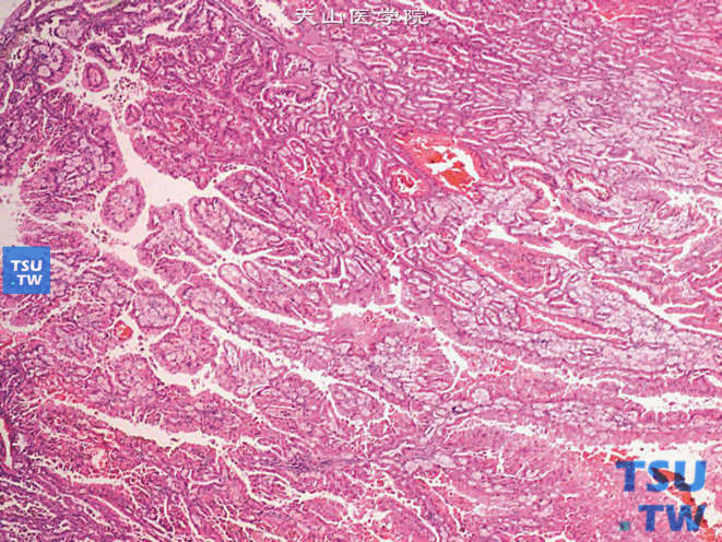 乳头状肾细胞癌，Ⅱ型，细胞呈高柱状，假复层排列，胞质嗜酸