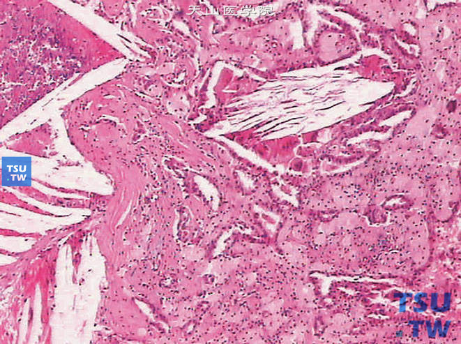 乳头型肾细胞癌。示胆固醇结晶