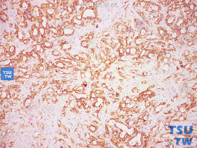 肾集合管癌，免疫组化：广谱角蛋白（+）