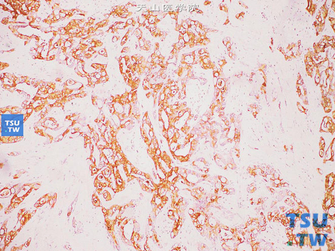 肾集合管癌，免疫组化：EMA（+）