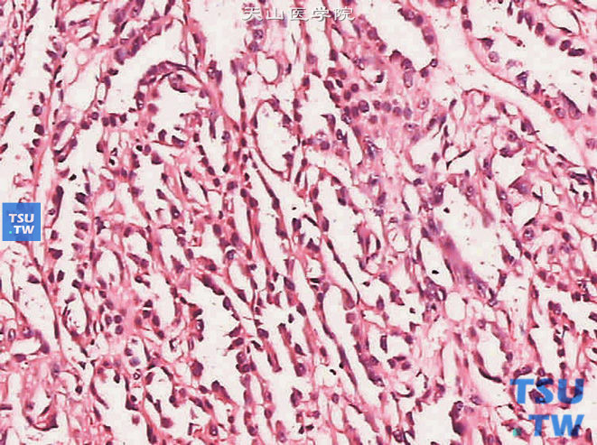 未分类的肾细胞癌，肾管状囊性癌（新分类），示瘤细胞呈钉突状