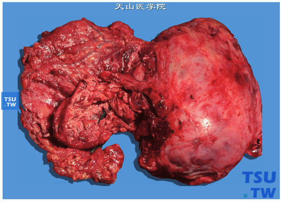 成人肾母细胞瘤。切面实性，质软，灰粉色，常有出血、坏死及囊腔形成