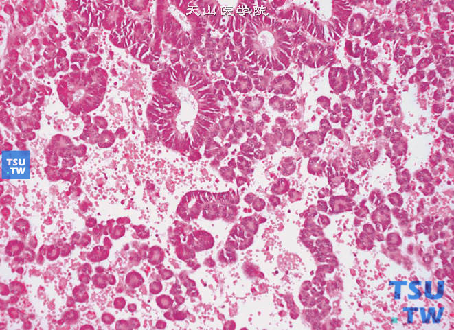 肾母细胞瘤。上皮性分化成分。瘤细胞排列呈小管状或菊形团样结构