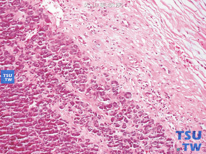 肾母细胞瘤。胚芽细胞呈弥漫型排列，缺乏细胞间黏着，侵入周围结缔组织