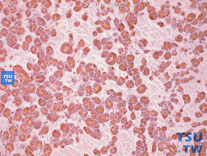 肾母细胞瘤。上皮性分化成分，广谱CK（+）