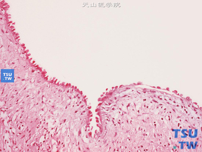 肾混合性上皮间质瘤（成人型中胚层肾瘤），部分被覆上皮呈钉突状，胞质透明、淡染或嗜酸
