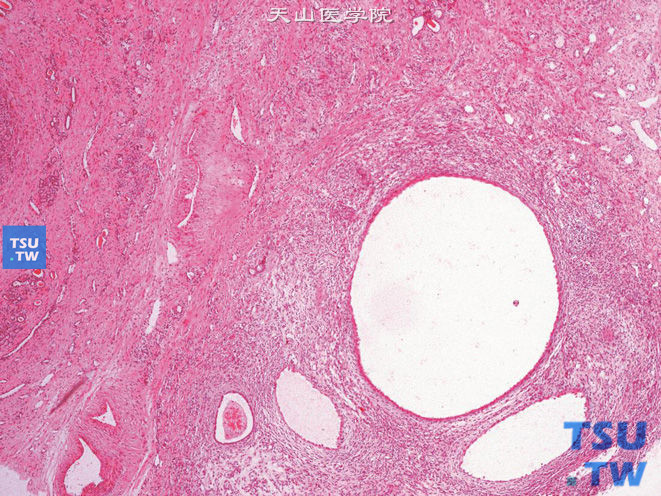 肾混合性上皮间质瘤，示囊性结构，被覆钉突状上皮细胞