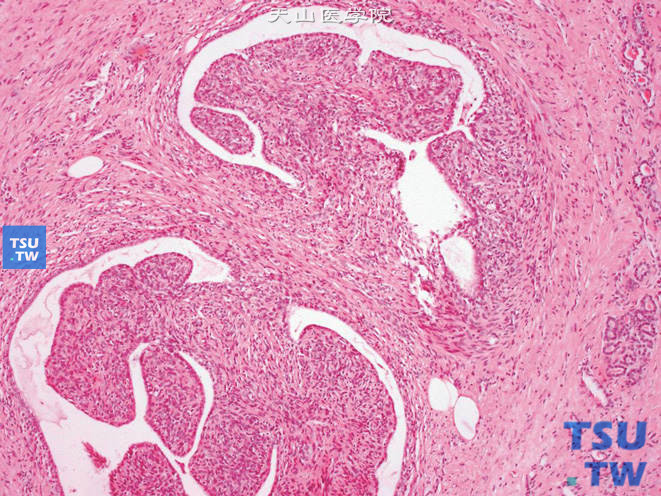 肾混合性上皮间质瘤，示粗大的乳头样结构