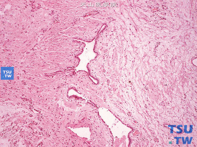 肾混合性上皮间质瘤（成人型中胚层肾瘤），示上皮呈分支的小管状结构，被覆立方上皮，间质可见束状平滑肌分化的梭形细胞