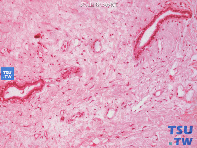 肾混合性上皮间质瘤（成人型中胚层肾瘤），示部分小管被覆立方上皮，间质为梭形细胞