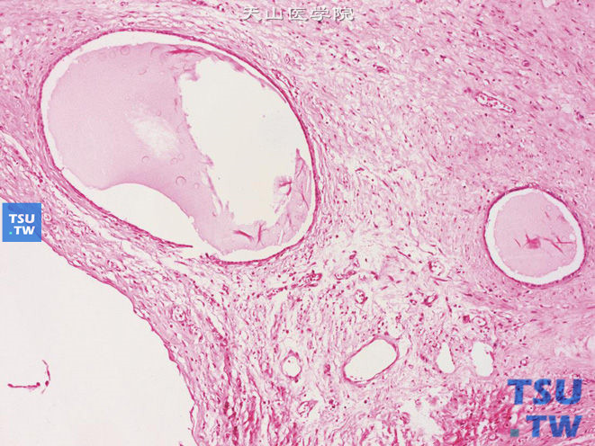 肾混合性上皮间质瘤（成人型中胚层肾瘤），部分区域上皮构成微囊状结构，被覆扁平或矮立方上皮