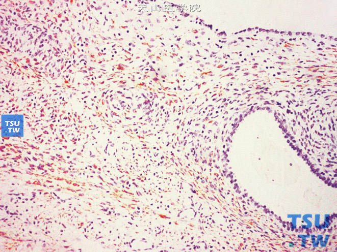 肾混合性上皮间质瘤，梭形细胞DES（+）