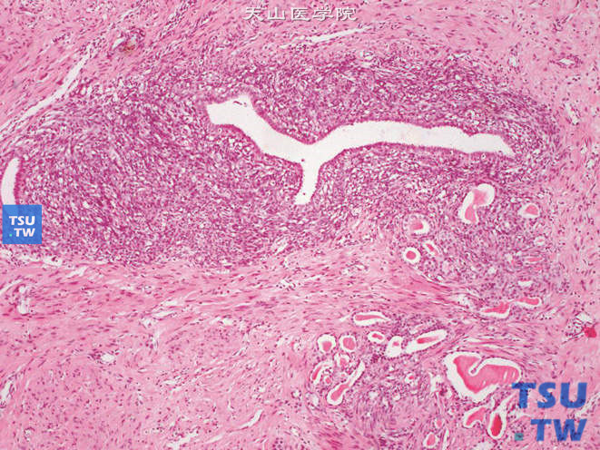 肾混合性上皮间质瘤，示管状结构，被覆立方或柱状上皮