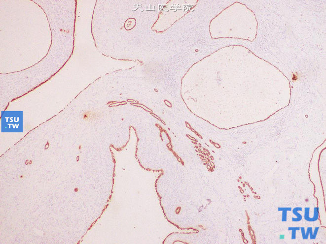 肾混合性上皮间质瘤，示上皮性成分广谱CK（+）