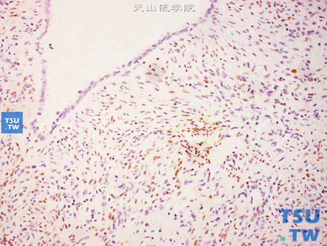 肾混合性上皮间质瘤，示梭形细胞核表达ER