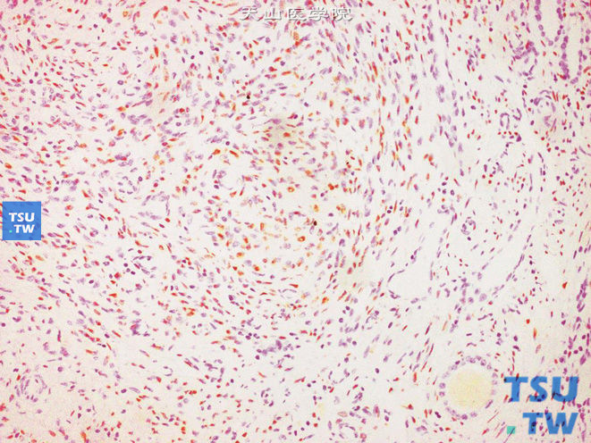 肾混合性上皮间质瘤，示梭形细胞核表达PR