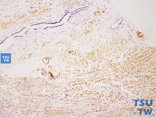 肾混合性上皮间质瘤（成人型中胚层肾瘤），梭形细胞SMA（+）