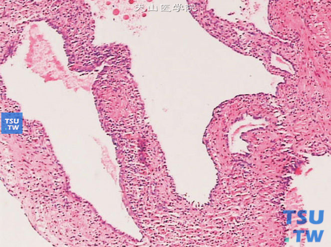 肾囊性肾瘤。示多房性囊腔互不连通