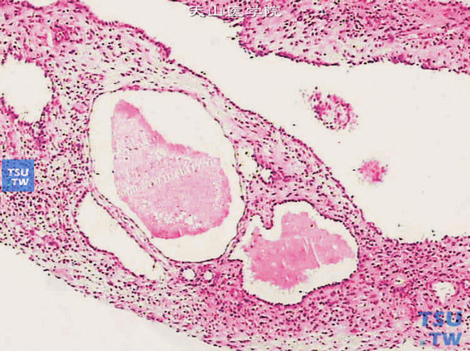 肾囊性肾瘤。可见多房性囊腔，囊腔间隔为黏液样间质