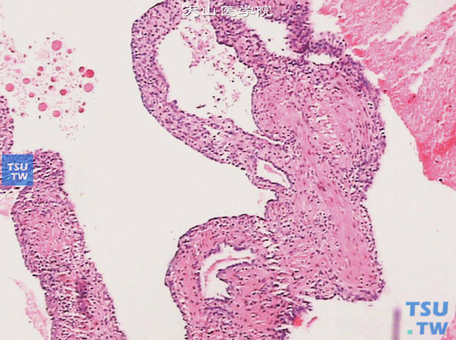 肾囊性肾瘤。可见多房性囊腔，囊腔间隔为胶原纤维