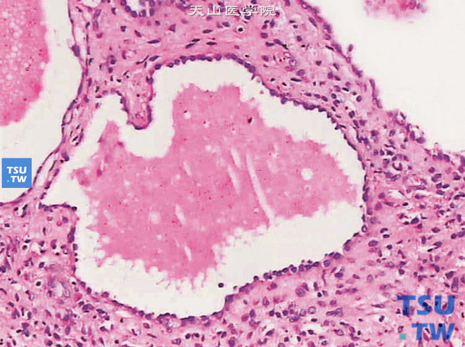 肾囊性肾瘤，被覆上皮呈钉突状