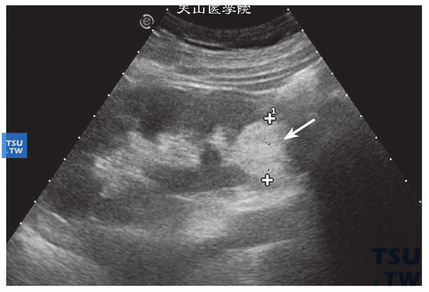 血管平滑肌脂肪瘤超声特点：大多形态规则，边缘整齐，高回声均匀分布，瘤体大小不一，单发或多发，小体积一般外形规则，表面光滑，回声均质，肾脏体积形态无大变化。瘤体较大时由于与周围脏器挤压，外形可以不规则，边缘欠整齐，肾脏大小形态结构也会由于瘤体挤压使肾脏形态失常。该病例肾下极可见类圆形高回声实性结节，表面光滑，回声均质