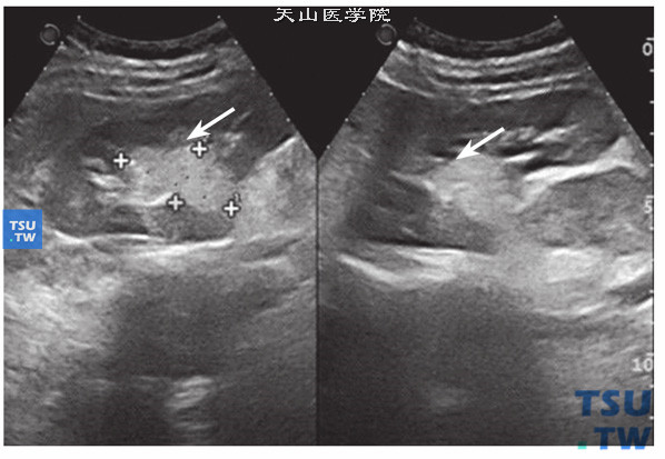 血管平滑肌脂肪瘤超声特点：高回声肿物位于肾门部，肿物向肾内生长，内部回声均质细腻，瘤体不大，肾脏无明显受压改变