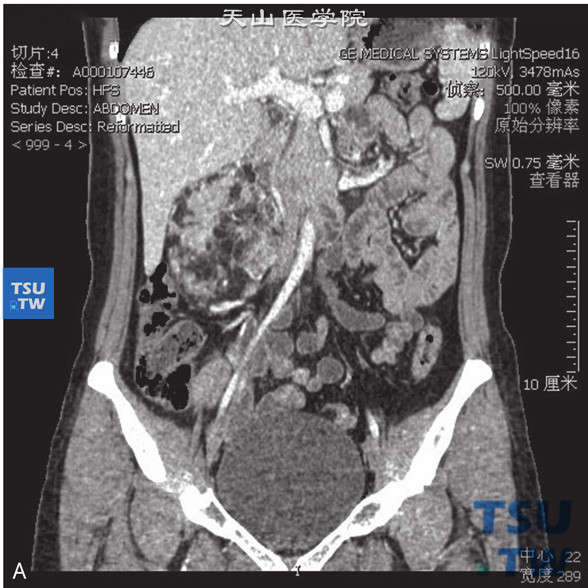 图A：肾血管平滑肌脂肪瘤，女，28岁，右肾占位。右肾实质内见一不均匀低密度灶突出肾轮廓外，外缘光整，其内见脂肪密度灶伴多发软组织索条，增强后软组织成分明显强化