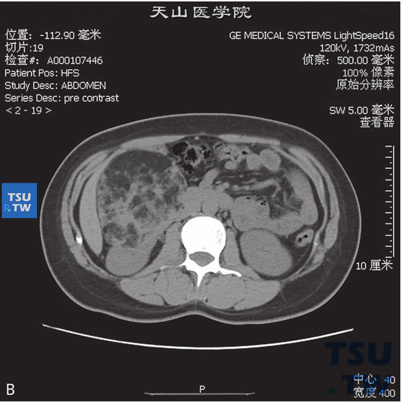 图B：肾血管平滑肌脂肪瘤，女，28岁，右肾占位。右肾实质内见一不均匀低密度灶突出肾轮廓外，外缘光整，其内见脂肪密度灶伴多发软组织索条，增强后软组织成分明显强化