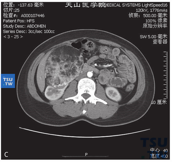 图C：肾血管平滑肌脂肪瘤，女，28岁，右肾占位。右肾实质内见一不均匀低密度灶突出肾轮廓外，外缘光整，其内见脂肪密度灶伴多发软组织索条，增强后软组织成分明显强化