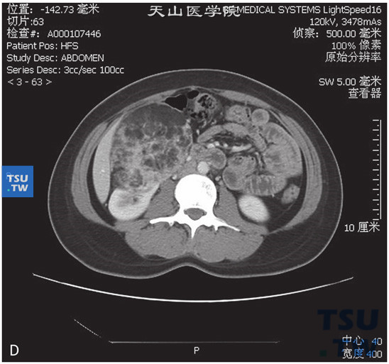 图D：肾血管平滑肌脂肪瘤，女，28岁，右肾占位。右肾实质内见一不均匀低密度灶突出肾轮廓外，外缘光整，其内见脂肪密度灶伴多发软组织索条，增强后软组织成分明显强化