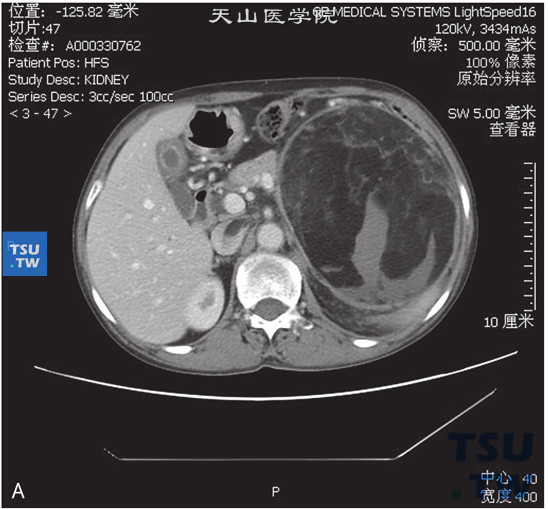 图A：CT，左肾错构瘤伴静脉内瘤栓，女，66岁，腹痛检查发现左肾肿物3个月余。左肾上极巨大占位，其内见大块状脂肪密度灶及不规则软组织密度灶。增强后软组织密度灶可见强化。左肾静脉及下腔静脉内可见充盈缺损