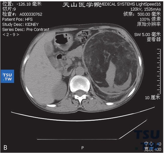 图B：CT，左肾错构瘤伴静脉内瘤栓，女，66岁，腹痛检查发现左肾肿物3个月余。左肾上极巨大占位，其内见大块状脂肪密度灶及不规则软组织密度灶。增强后软组织密度灶可见强化。左肾静脉及下腔静脉内可见充盈缺损