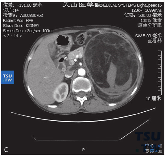 图C：CT，左肾错构瘤伴静脉内瘤栓，女，66岁，腹痛检查发现左肾肿物3个月余。左肾上极巨大占位，其内见大块状脂肪密度灶及不规则软组织密度灶。增强后软组织密度灶可见强化。左肾静脉及下腔静脉内可见充盈缺损