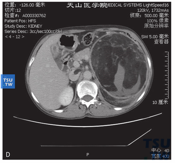 图D：CT，左肾错构瘤伴静脉内瘤栓，女，66岁，腹痛检查发现左肾肿物3个月余。左肾上极巨大占位，其内见大块状脂肪密度灶及不规则软组织密度灶。增强后软组织密度灶可见强化。左肾静脉及下腔静脉内可见充盈缺损