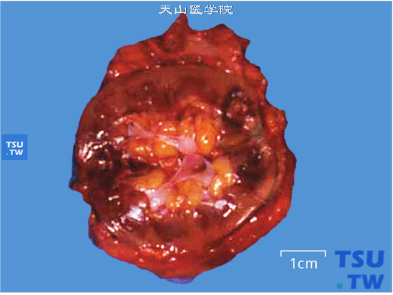 肾血管平滑肌脂肪瘤。肿瘤无包膜，切面黄色，有出血（大体）