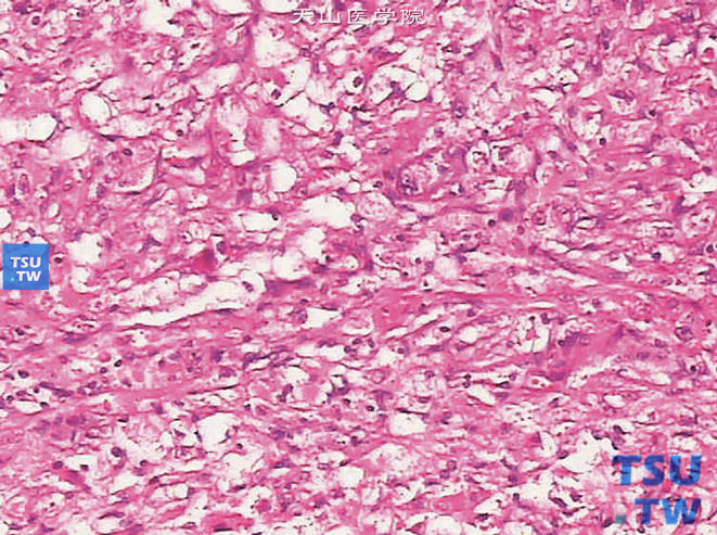 上皮样血管平滑肌脂肪瘤。可见增生的上皮样细胞呈巢片状排列，伴有梭形细胞