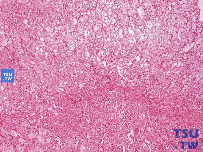 肾上皮样血管平滑肌脂肪瘤，肿瘤中可出现多少不等的透明细胞，有时透明细胞成分可很突出（图中上方）。注意图下方的上皮样细胞
