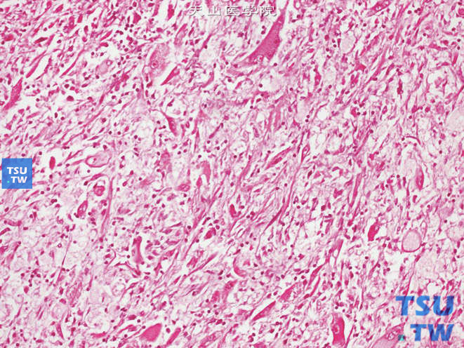 肾上皮样血管平滑肌脂肪瘤，由大小不等的多角形和梭形细胞组成，可见多核细胞及神经节细胞样细胞，并混有炎症细胞