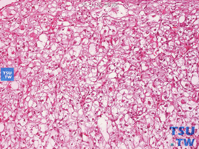肾上皮样血管平滑肌脂肪瘤，示透明细胞核呈囊泡状，核仁突出