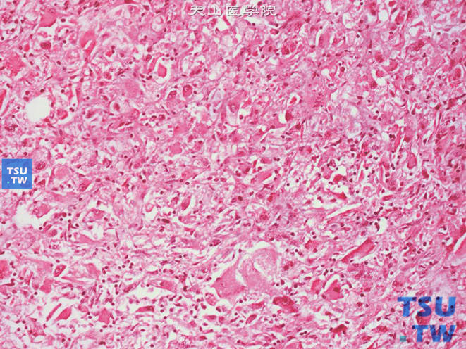 肾上皮样血管平滑肌脂肪瘤，示上皮样细胞有丰富的颗粒状胞质，圆形或多角形，细胞核较大，囊泡状，核仁明显