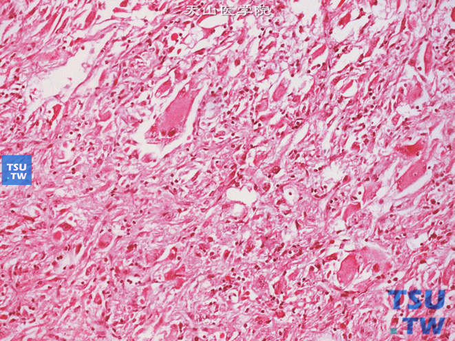 肾上皮样血管平滑肌脂肪瘤，可见多核细胞