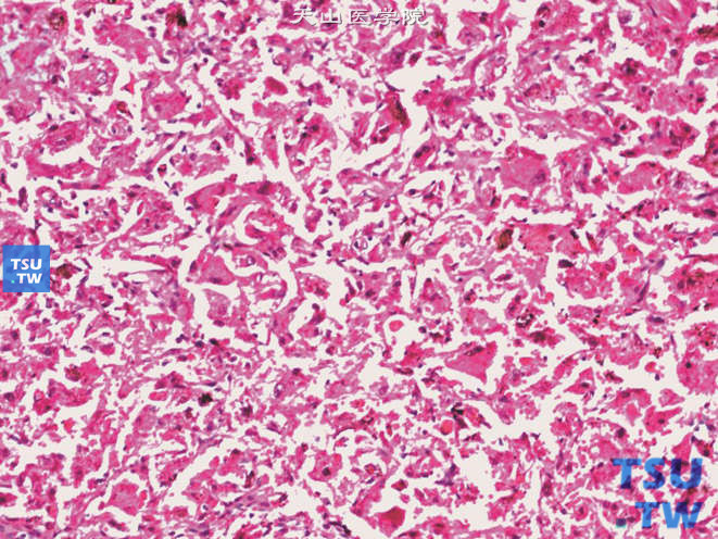 肾上皮样血管平滑肌脂肪瘤，可见丰富的颗粒状胞质。部分细胞大，多核，部分细胞呈神经节细胞样表现