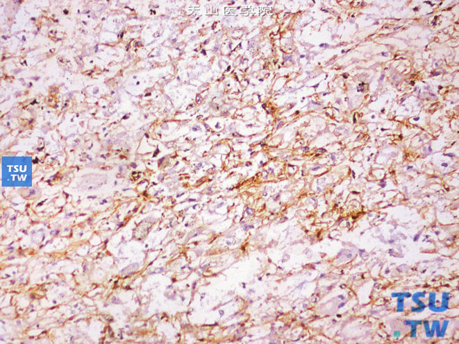 肾上皮样血管平滑肌脂肪瘤，部分细胞SMA（+）