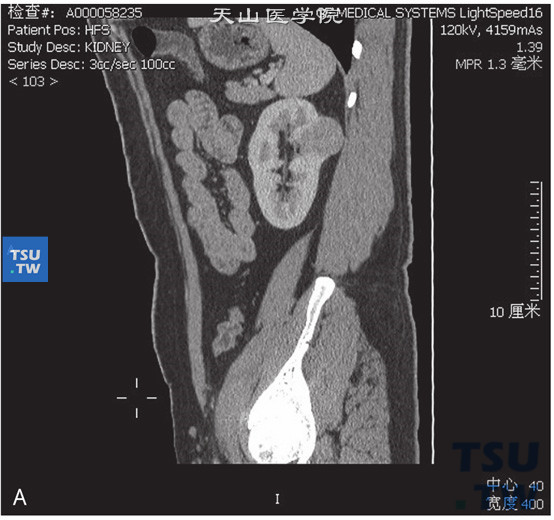 图A：CT，肾平滑肌瘤，男，51岁，体检左肾占位。左肾实质内见一略高密度灶凸出肾轮廓外，边缘清晰，增强后中度强化，皮质期及实质期病灶持续强化